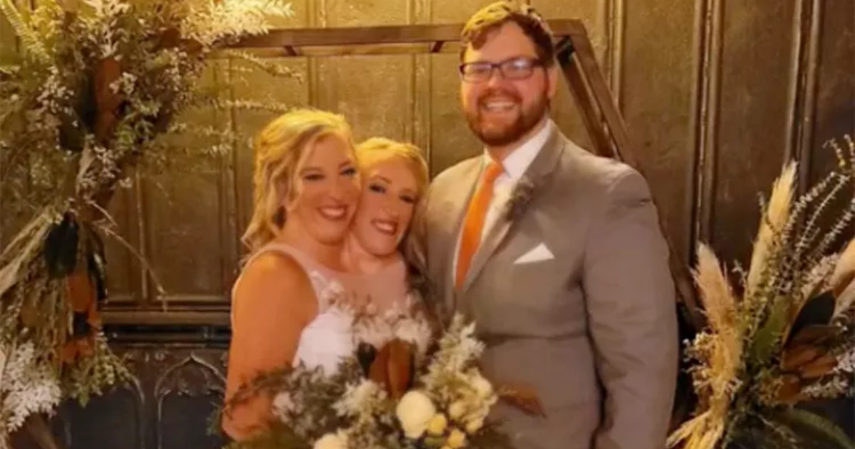 Brittany Abby conjoined baby