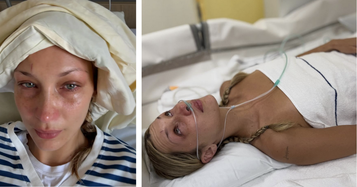 Bella Hadid Lyme disease