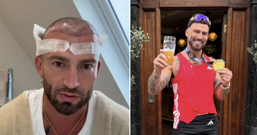 Jake Birth Jake Quickenden compares hair transplant to giving birth