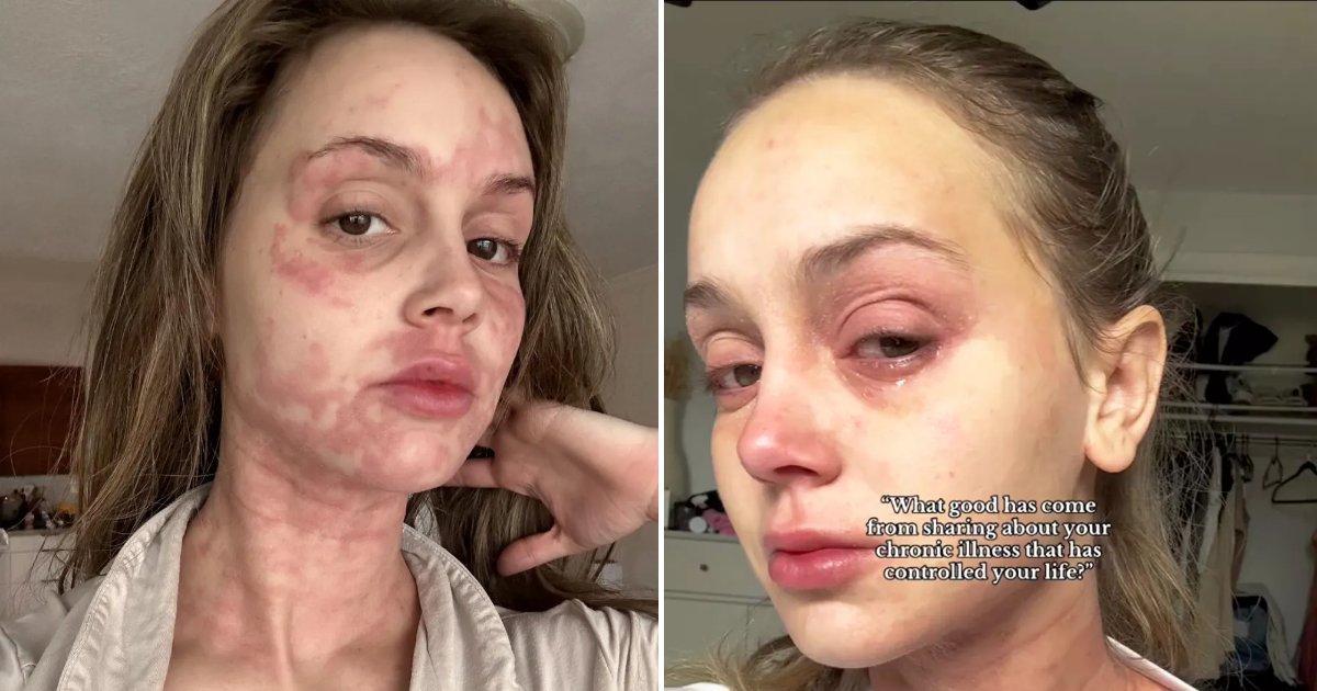 Mikayla skin condition Secret Lives Mormon Wives