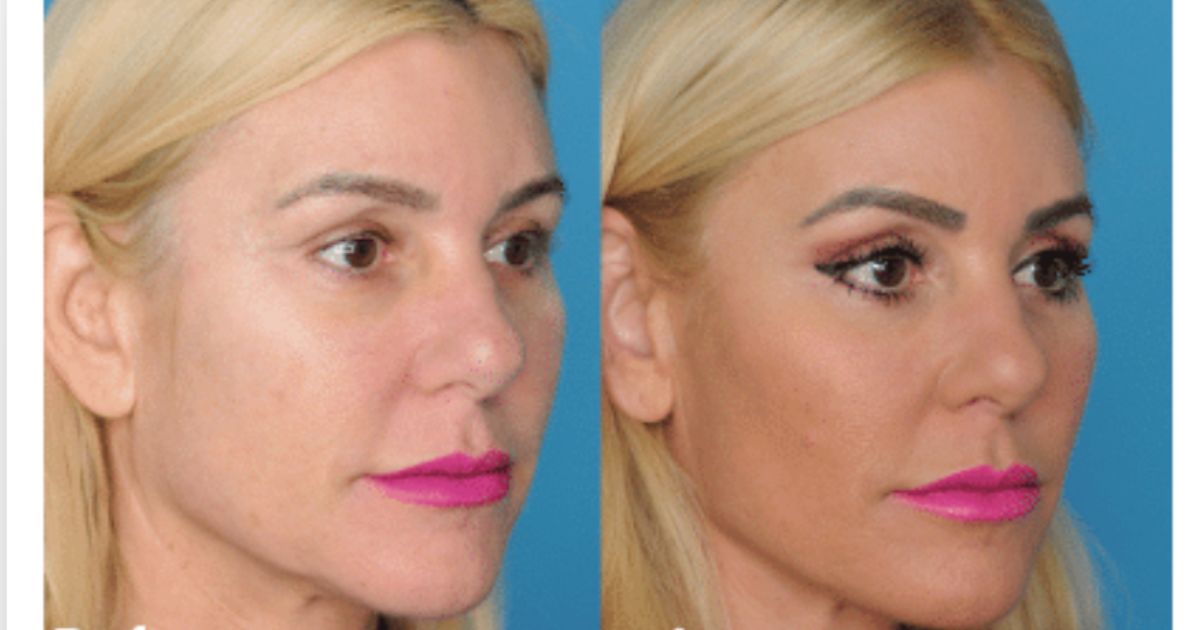 rosalyn plastic surgery Members Only Palm Beach