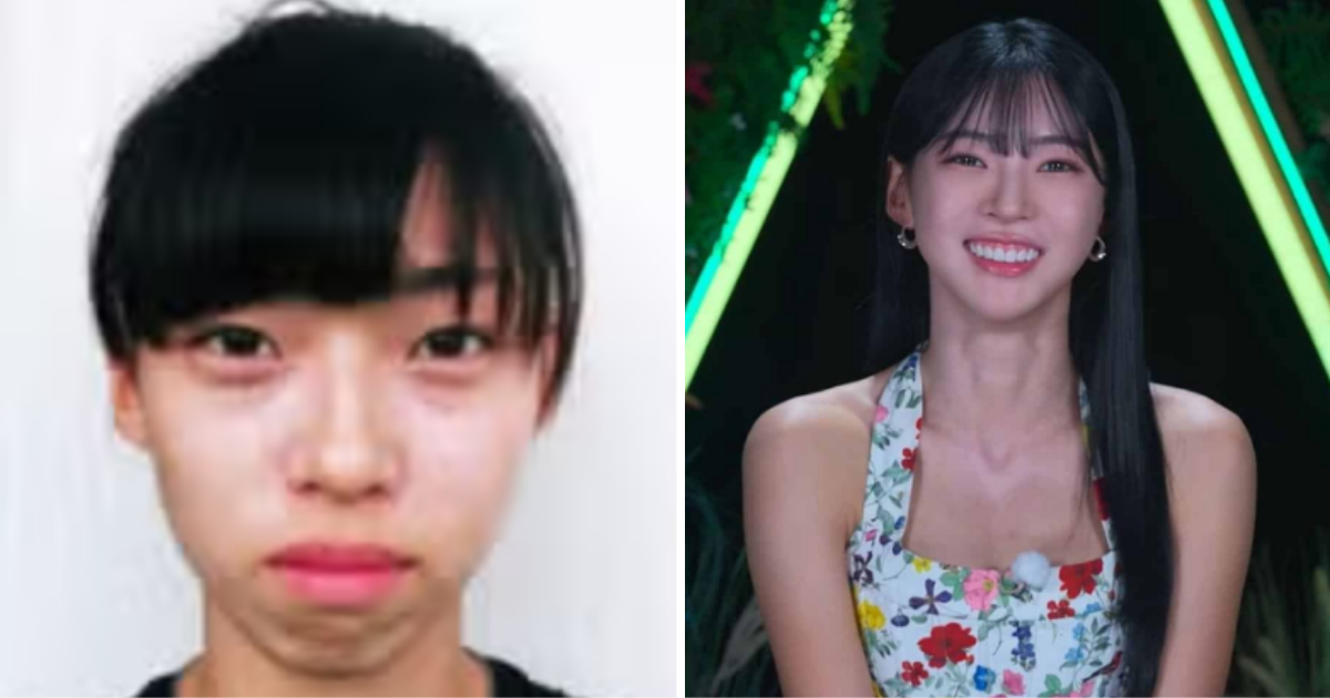 Single's Inferno Kim Min-gee plastic surgery