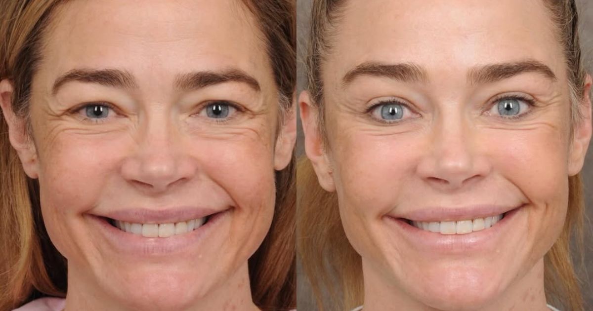 Denise Richards facelift