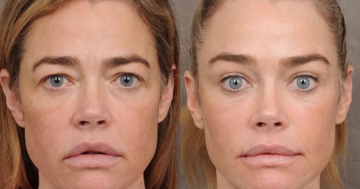 Denise Richards facelift