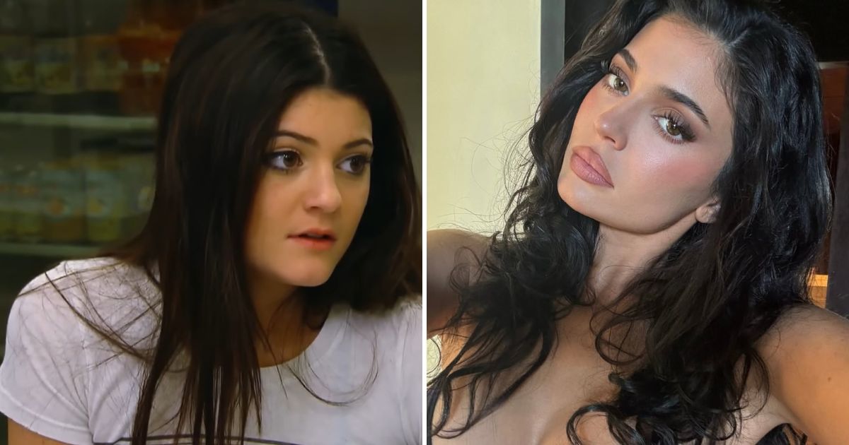 kylie jenner lip dissolved